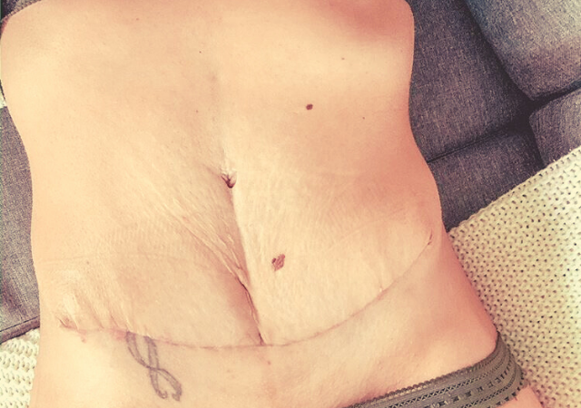 témoignage de Lore sur son abdominoplastie pour se reconstruire après un diastasis des grands droits